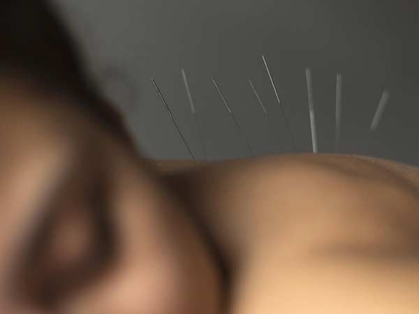 Slimming Acupuncture slimming-acupucture